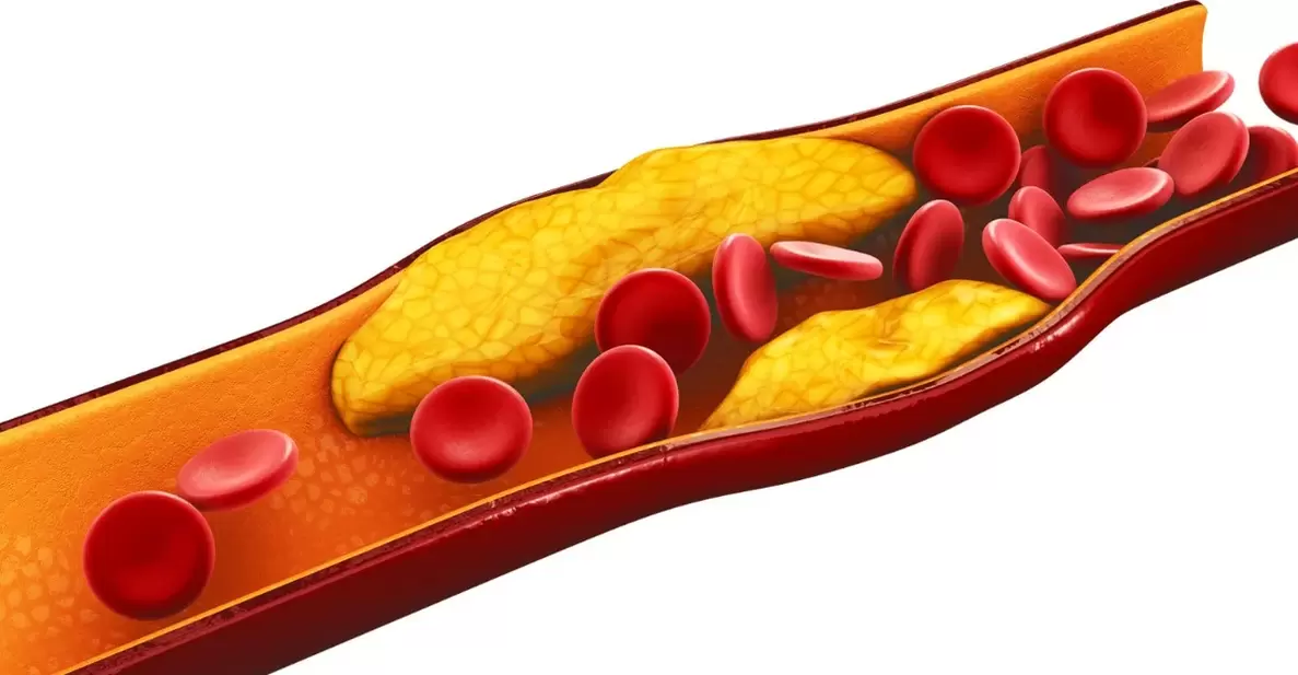 a razão para tomar cápsulas MiCardium é a aterosclerose vascular